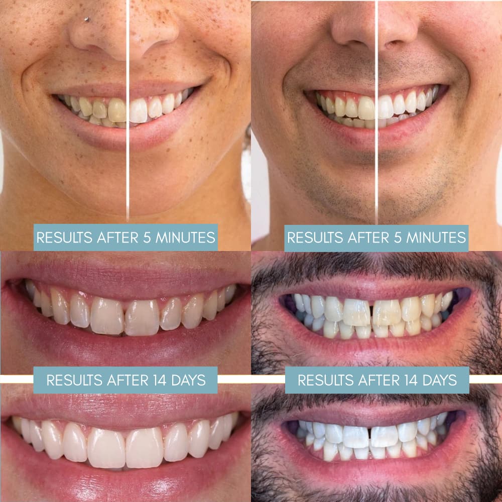 Teeth Whitening Pen